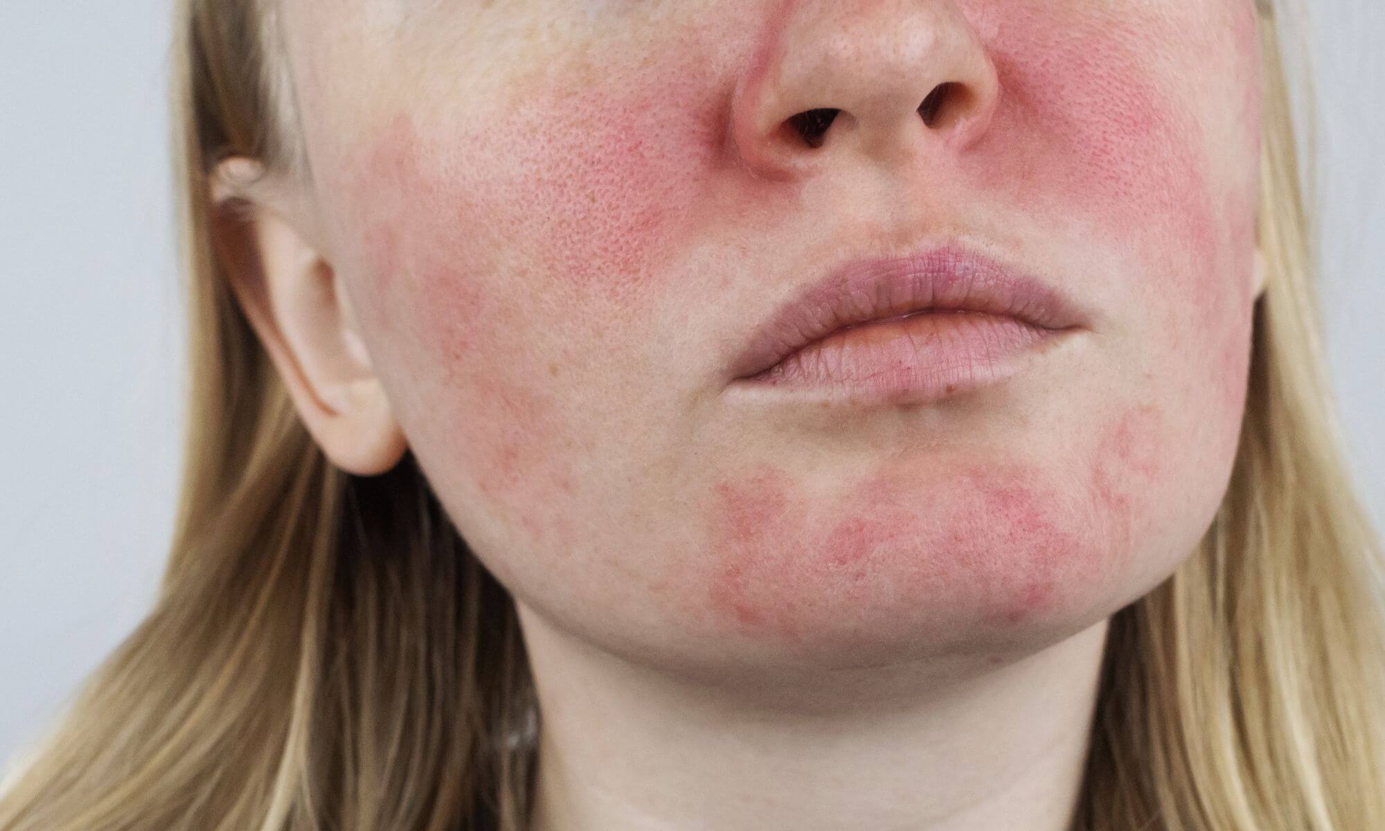 Wie pflege ich meine Rosacea Haut?