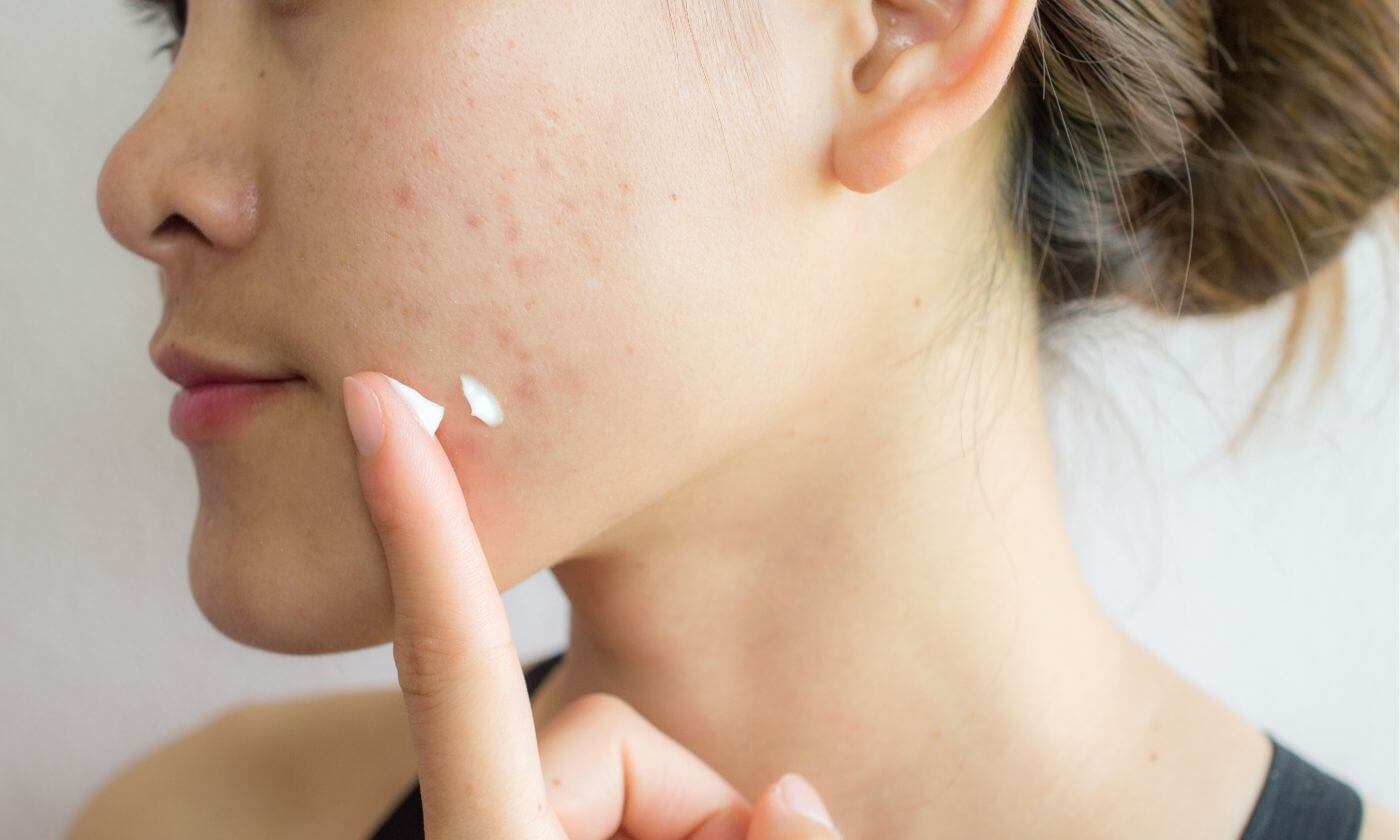 Junge Aknehaut – was nun und was tun?